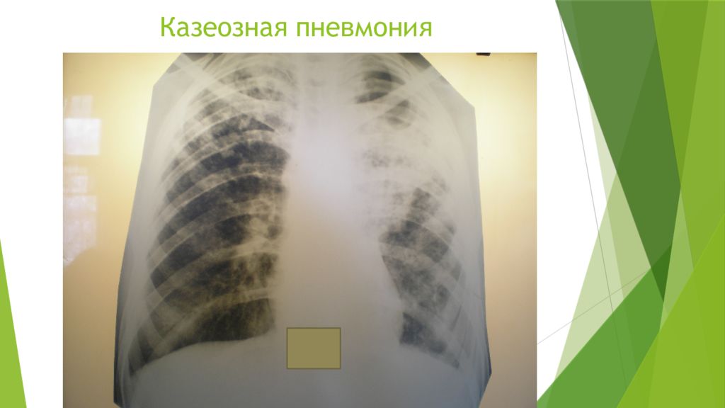 Казеозная пневмония рентген. Казеозная пневмония дифференциальная диагностика. 80 поражения легких