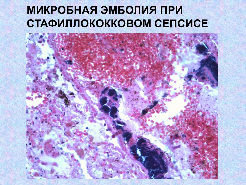 Сепсис легких. Сепсис пупочный сепсис патанатомия. Бактериальная эмболия. Микробная эмболия исход.