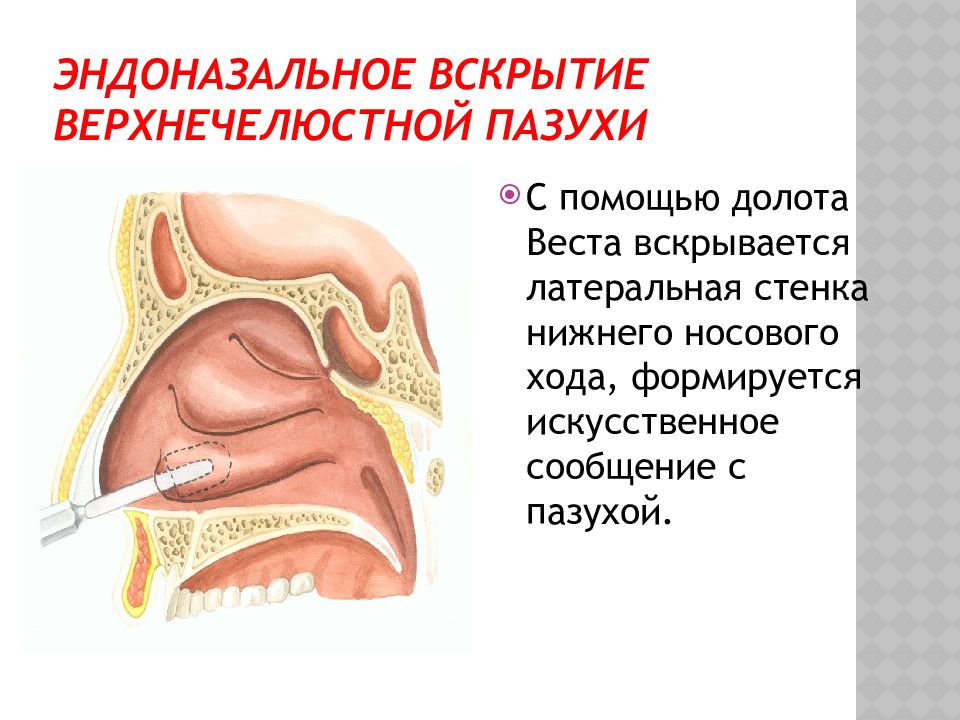 Верхнечелюстной синусит у детей