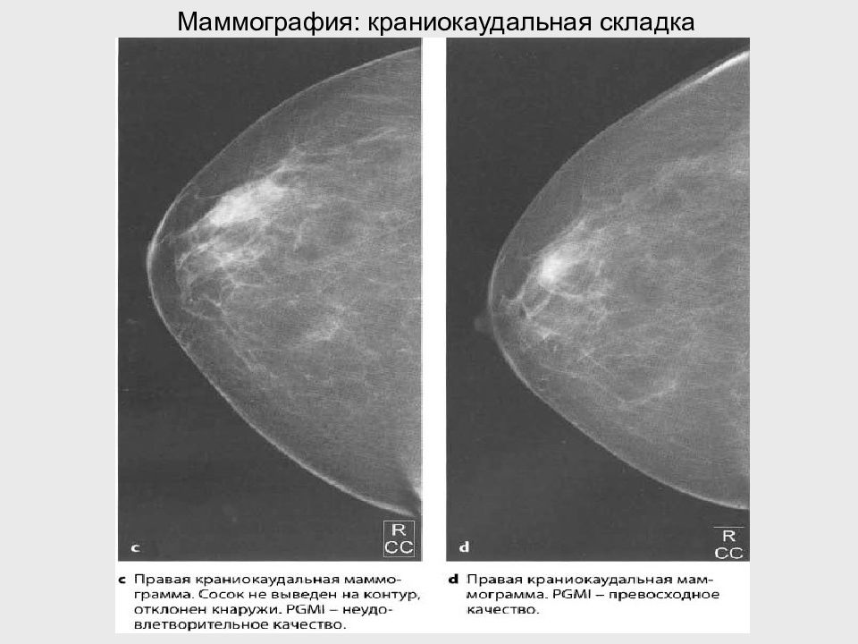 Маммография ответы. Маммография молочных желез в норме у женщин. Молочные железы маммография норма. Прицельная маммография 1 проекция.