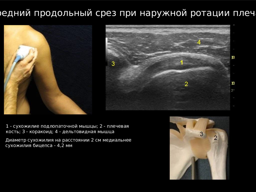 Узи плечевого. УЗИ плечевого сустава норма. Ультразвуковая анатомия плечевого сустава. Разрыв ротаторной манжеты УЗИ. УЗИ анатомия плечевого сустава.