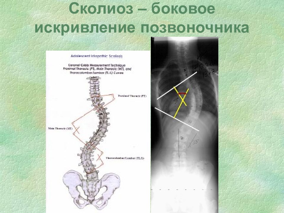 Пороки развития опорно двигательного аппарата презентация