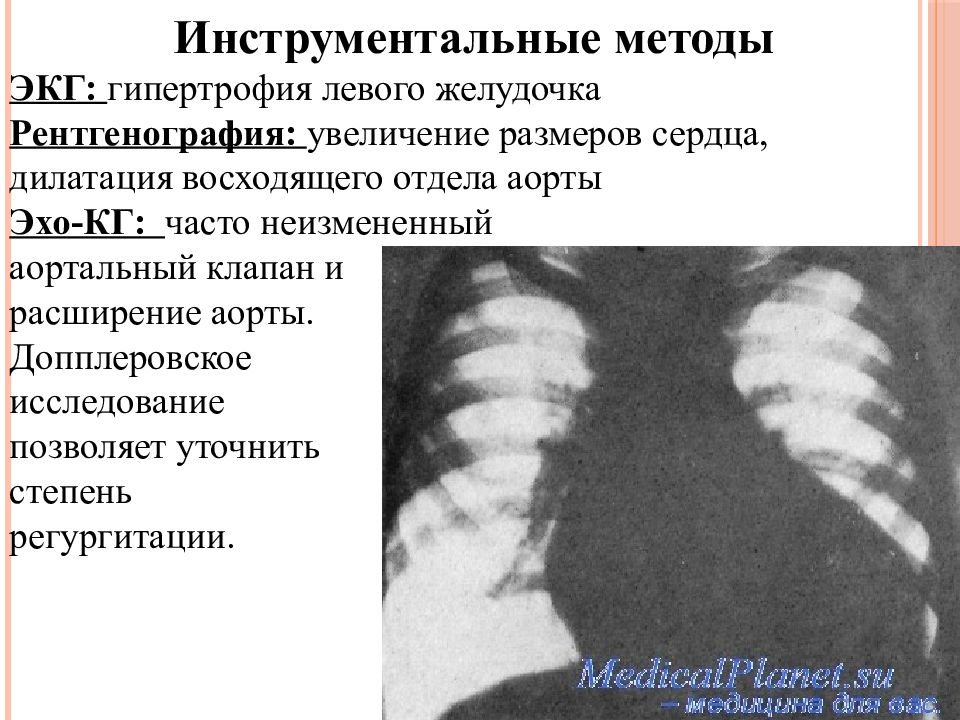 Дилатация правых отделов. Гипертрофия левого желудочка рентген. Гипертрофия сердца на рентгене. Гипертрофия левого желудочка сердца рентген. Рентген при гипертрофии левого желудочка.