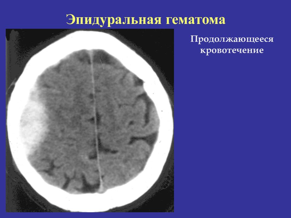 Эпидуральная гематома на кт