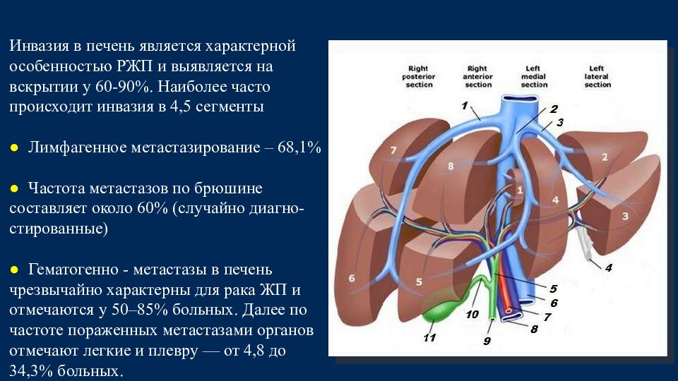 Рак желчного пузыря. Опухоль желчного пузыря клиника. Сегменты печени с желчными путями. Пути инвазии печеночного.