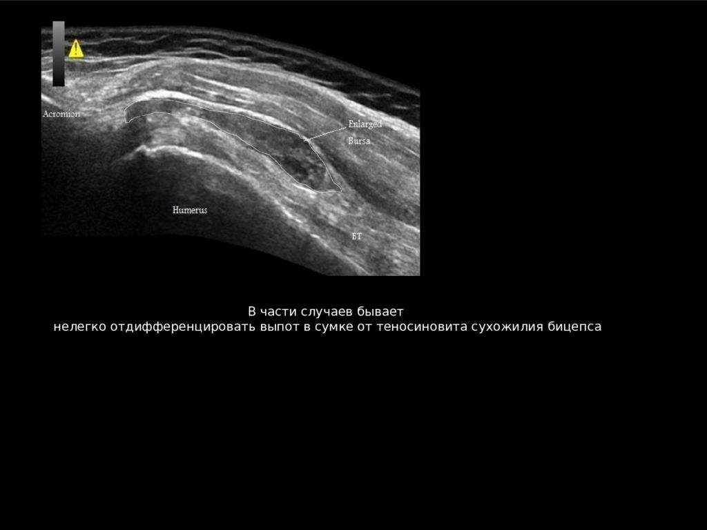 Узи плечевого. Синовит плечевого сустава на УЗИ. УЗИ анатомия плечевого сустава. Капсула плечевого сустава на УЗИ. УЗИ плечевого сустава лекция.