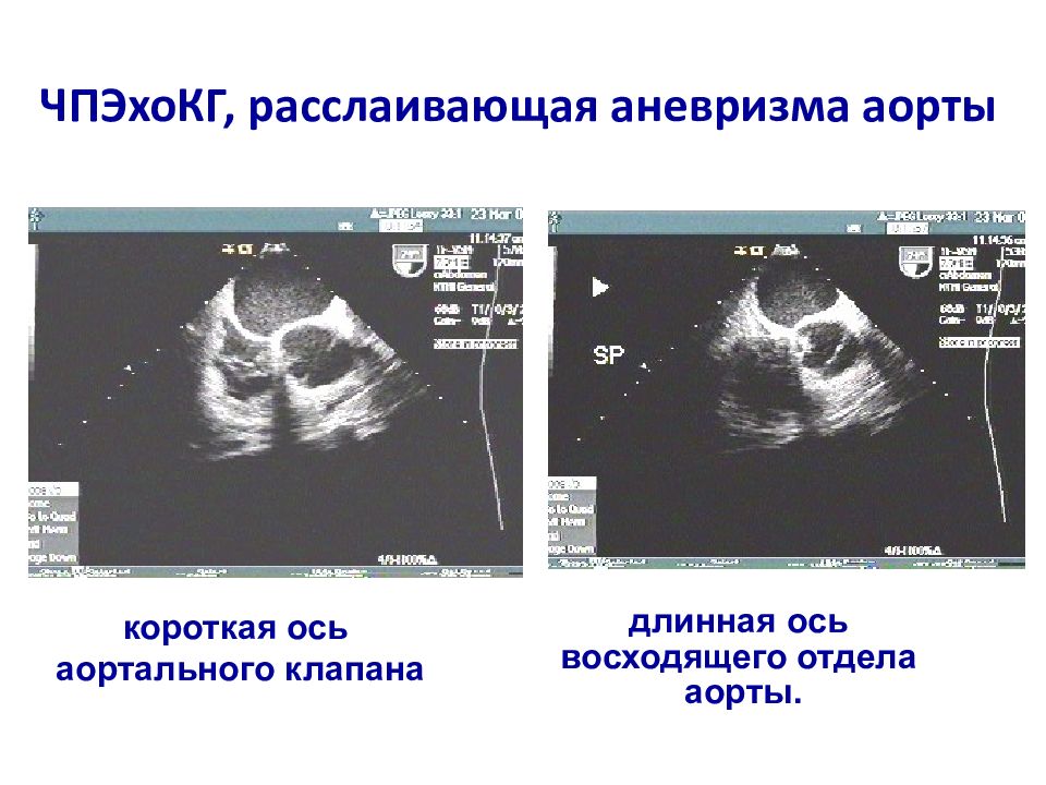 Расслаивающая аневризма карта вызова