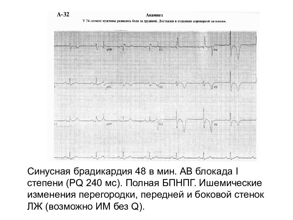Блокада код по мкб 10. АВ блокада при инфаркте миокарда. ЭКГ после коронарного шунтирования. Инфаркт миокарда брадикардия. ЭКГ изменения при острой коронарной патологии.