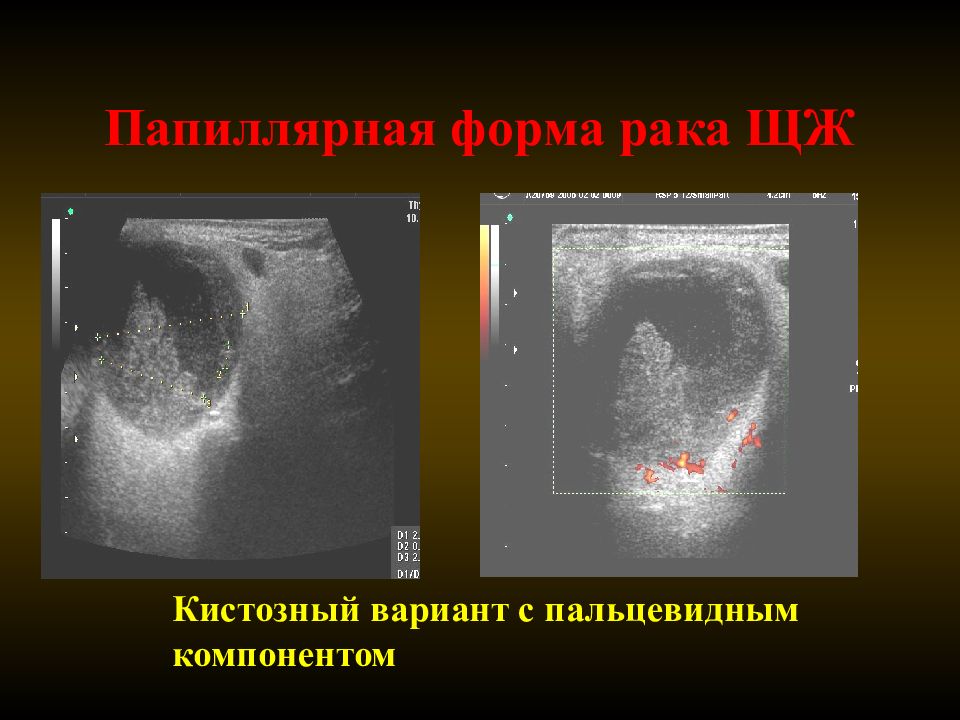 Папиллярный рак после операции. Опухоль щитовидной железы УЗИ. Папиллярная карцинома щитовидной железы УЗИ. Ультразвуковая картина щитовидной железы. Злокачественное образование в ЩЖ.