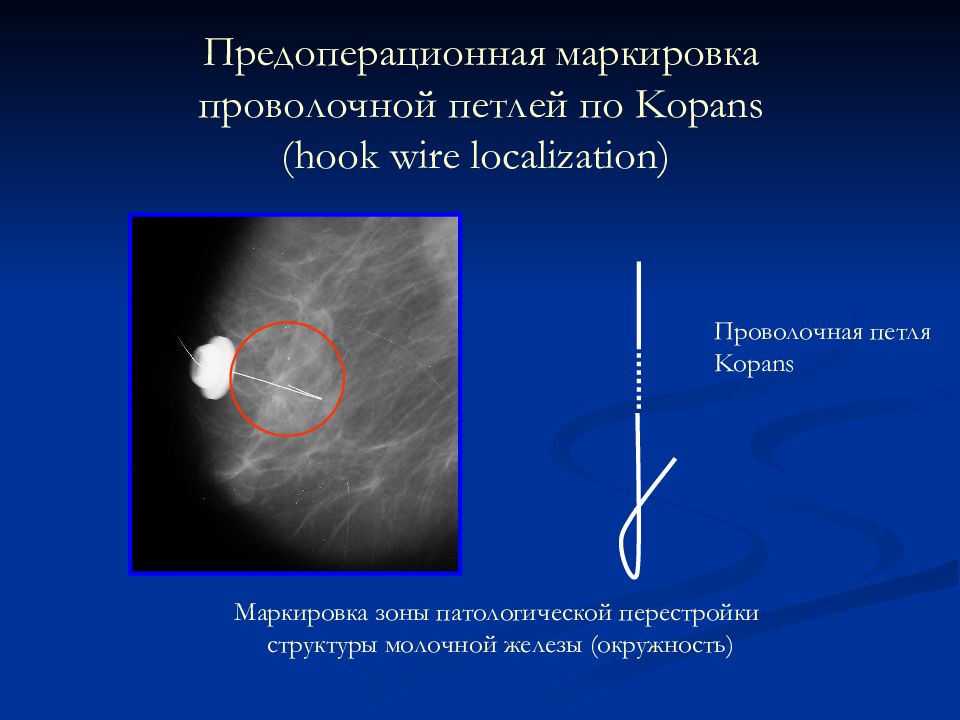 Лучевая рак молочной железы. Предоперационная маркировка молочной железы. Маркировка предоперационная опухоли молочной железы. Внутритканевая маркировка опухоли молочной железы. Рентгенодиагностика заболеваний молочной железы.