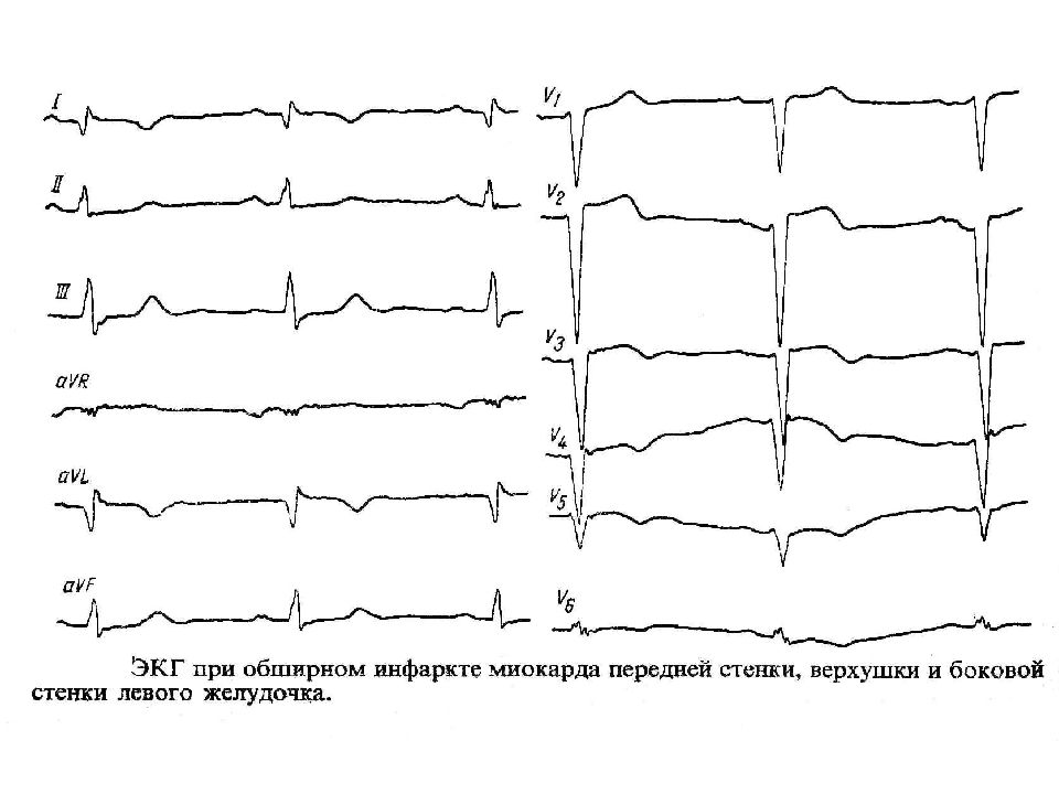 Нарушение по боковой стенке. Инфаркт миокарда передней стенки ЭКГ. ЭКГ при инфаркте миокарда передней стенки. Инфаркт миокарда классификация ЭКГ. ЭКГ инфаркт миокарда передней перегородки.