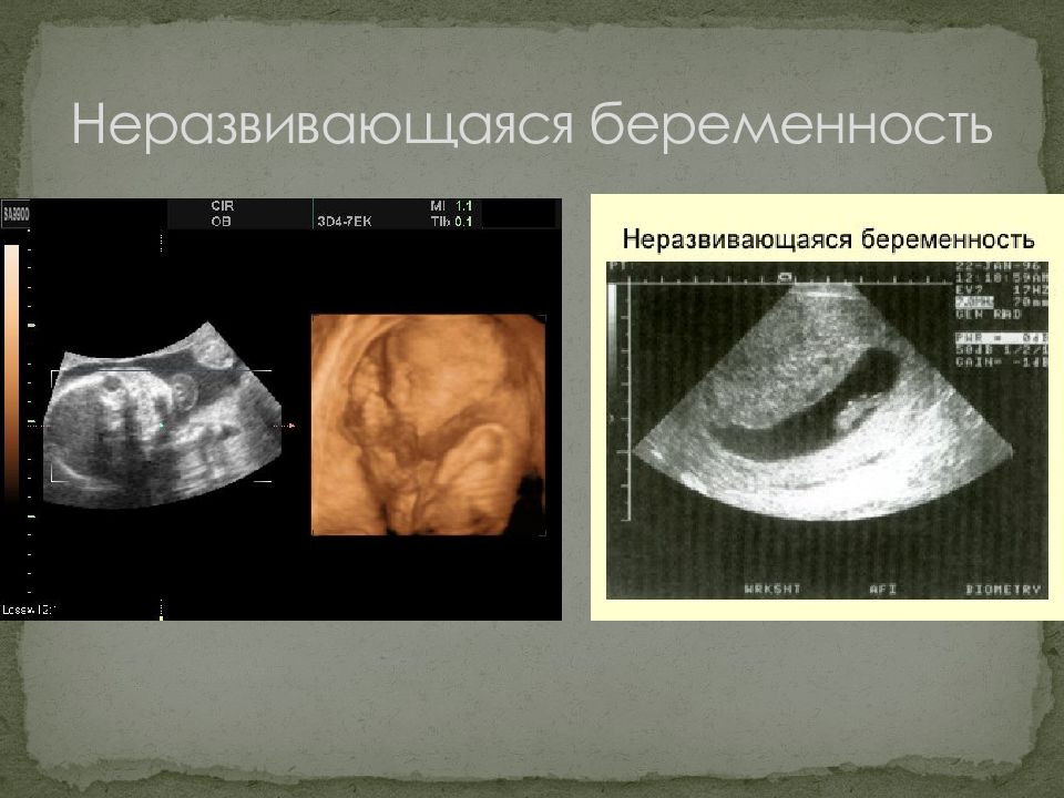Причины неразвивающейся беременности. Неразвивающаяся беременность. Неразвивающаяся беременность УЗИ. Неразвивающаяся беременность причины. Неразвивающаяся беременность 6 недель.