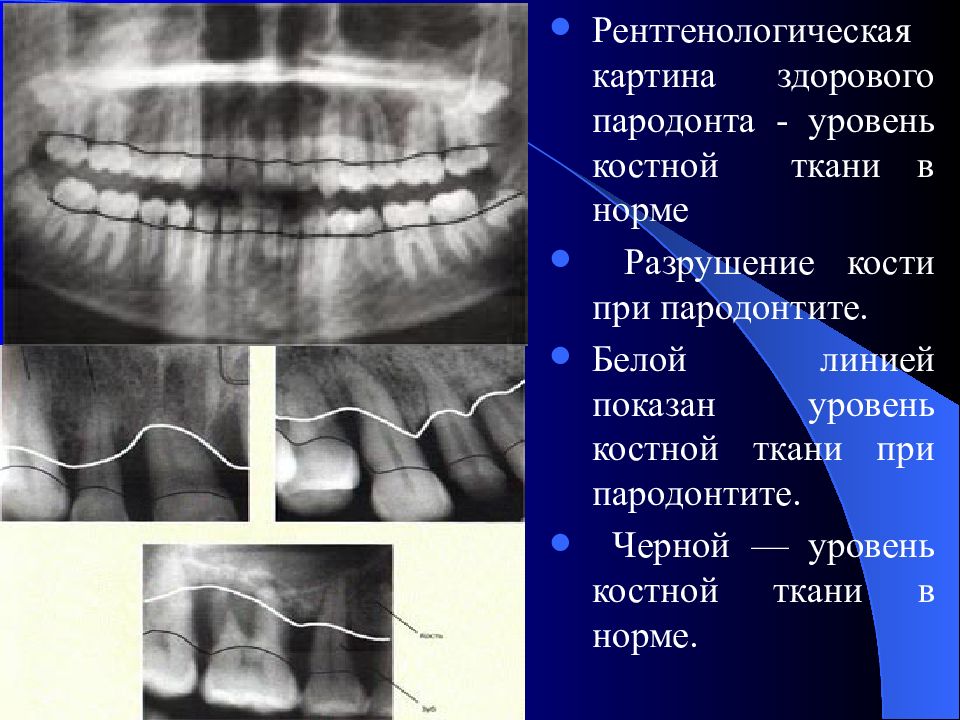 Рентгенологическая картина здорового пародонта