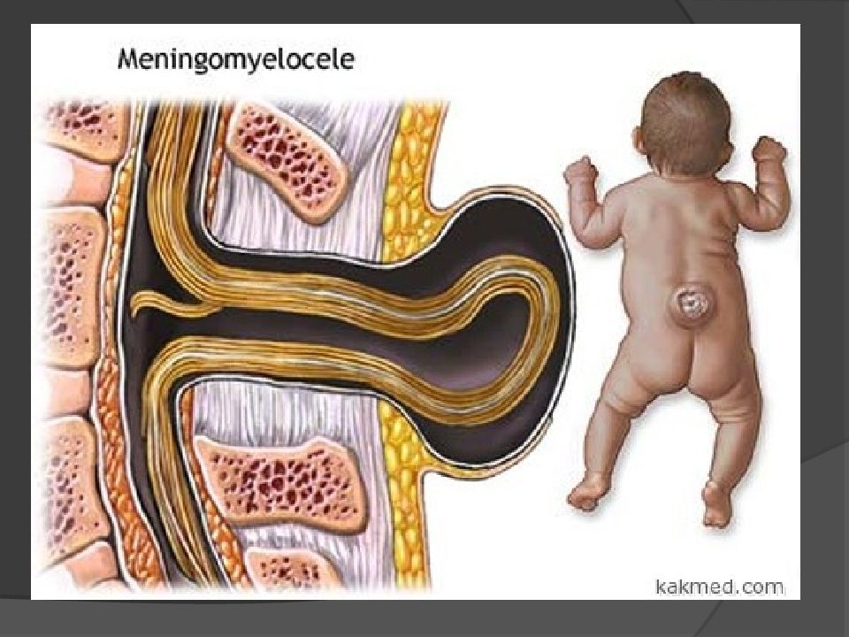 Спинномозговые грыжи презентация