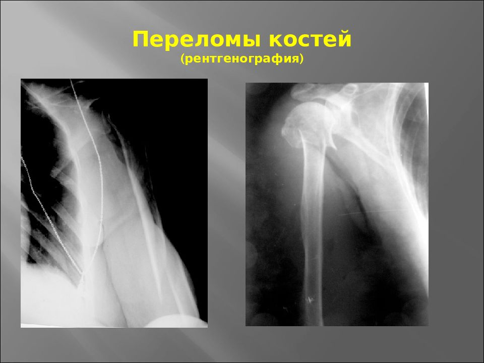 Продольный перелом рентген. Трещина кости на рентгеновском снимке. Оптимальная жесткость рентгенограммы. Жесткость рентгеновского снимка.