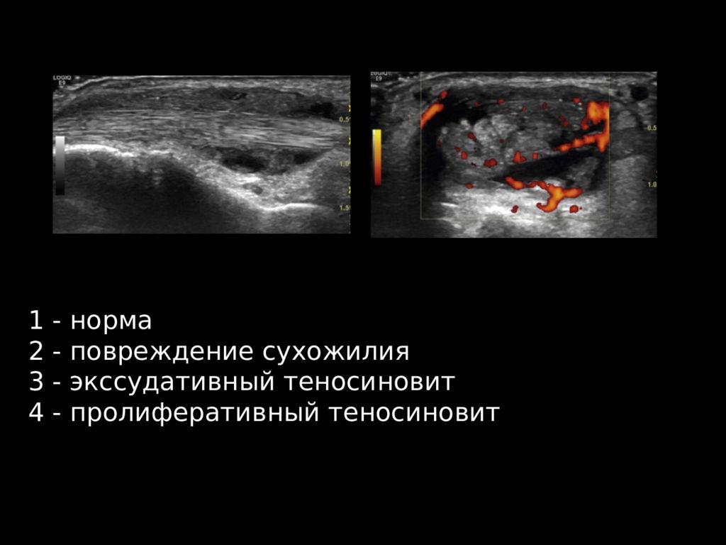 Узи кисти. Теносиновит на УЗИ. Повреждения сухожилий УЗИ. Разрыв ахиллова сухожилия на УЗИ.