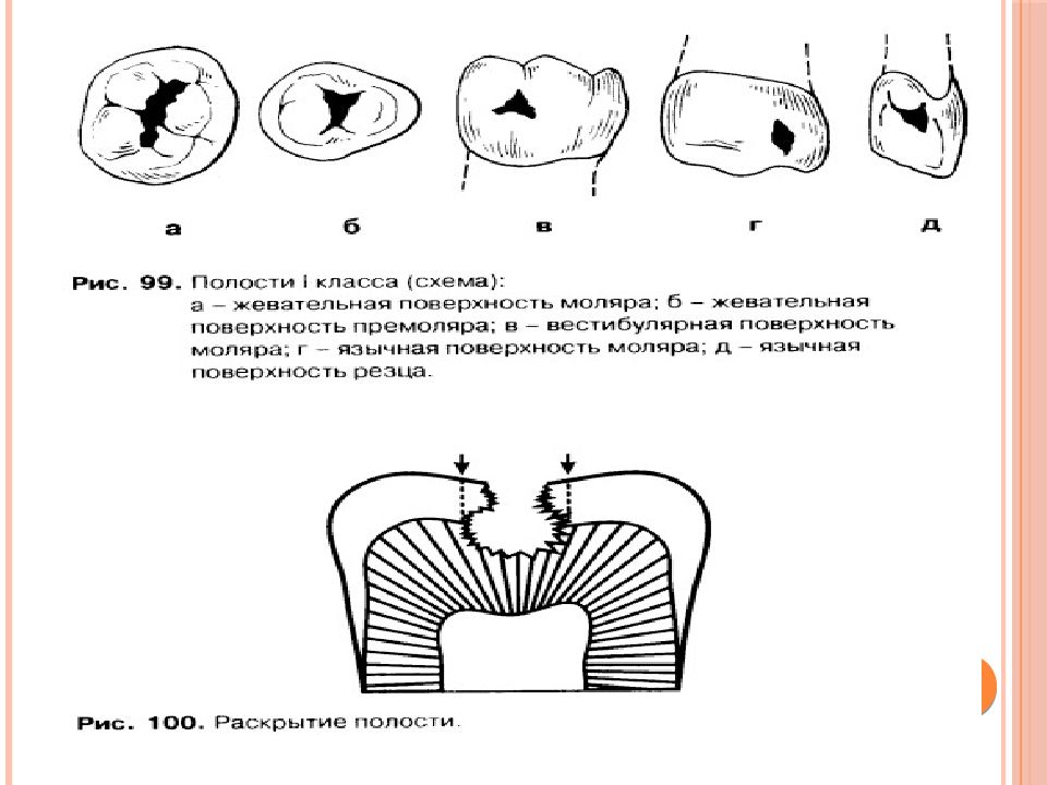 Размер кариозной полости. Схема ориентировочных действий при препарировании полостей 1 класса. Кариозная полость 1 класса. Препарирование кариозных полостей. Элементы кариозной полости.