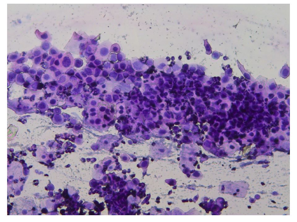 Аденокарцинома цитологическая картина