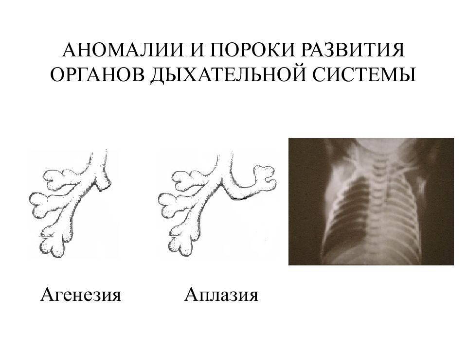 Аномалии развития. Врожденные пороки развития дыхательной системы. Филогенетические пороки развития дыхательной системы. Эволюция пороков развития дыхательной системы. Пороки дыхательной системы у новорожденных.