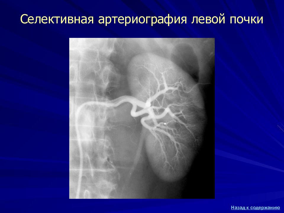 Почечная ангиография презентация