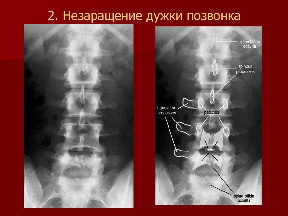 1 рентген. Незаращение дужки s1 позвонка у ребенка. Незаращение s1 позвонка. Незаращение дужки l5 позвонка рентген. Незаращение дужки l5 позвонка.