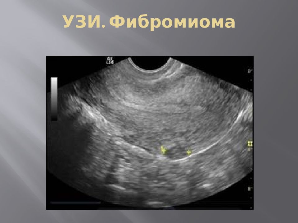 Фибромиома. Гиперплазия яичника на УЗИ. Ретенционная киста яичника на УЗИ. Ретенционное образование яичника УЗИ.