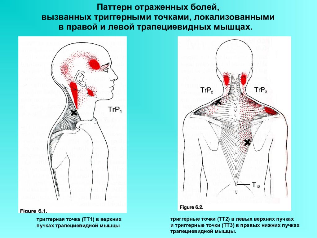 Болит голова и мышцы шеи. Тт1 триггерная точка. Миофасциальные триггерные точки спины. Ременная мышца головы триггерные точки.