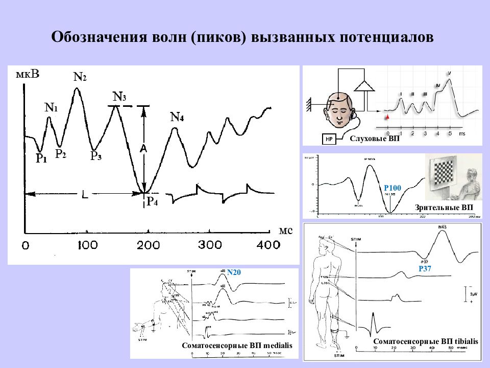 Регистрация слуховых вызванных потенциалов. Коротколатентные слуховые вызванные потенциалы (КСВП). Нормы слуховых вызванных потенциалов. КСВП исследование слуха. Вызванные потенциалы n400.