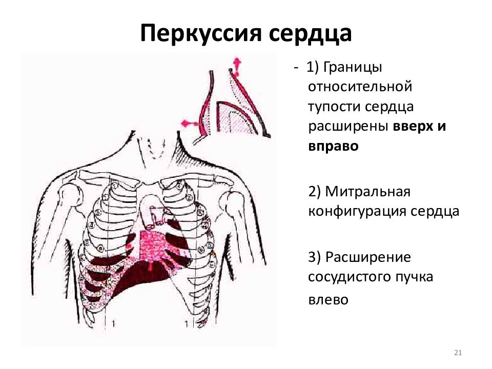 Границы относительной тупости сердца