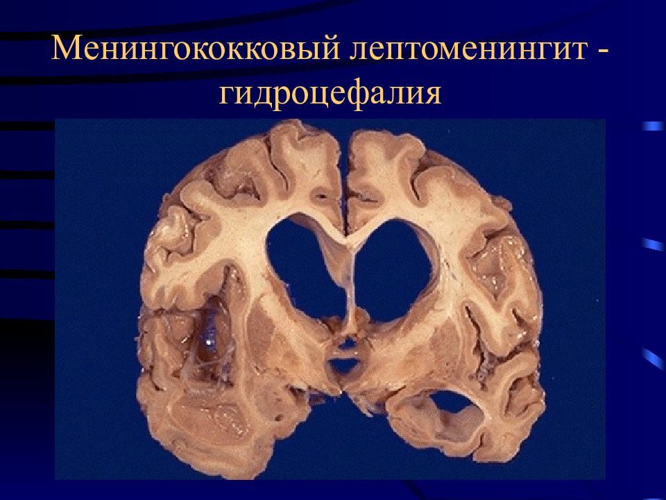 Расширение желудочков. Гидроцефалия головного мозга макропрепарат. Гидроцефалия расширение желудочков. Атрофия головного мозга макропрепарат гидроцефалия. Гидроцефалия патанатомия.