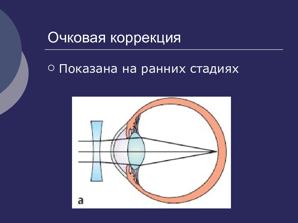 Презентация на тему кератоконус