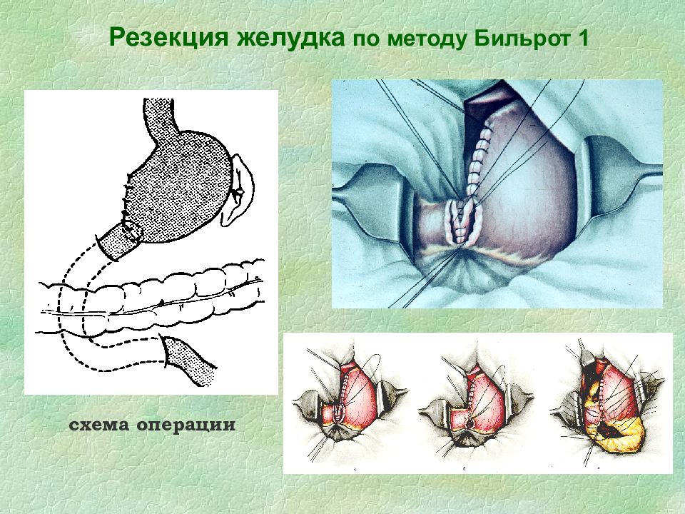 Резекция желудка. Резекция желудка Бильрот 1. Резекция желудка по Бильрот 1 техника. Резекция желудка Бильрот 1 схема. Операция на желудке Бильрот 1.