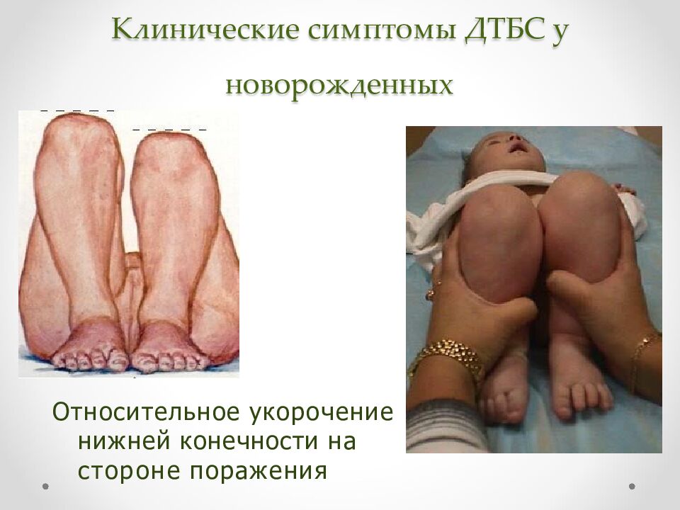 Клинические симптомы ДТБС у новорожденных