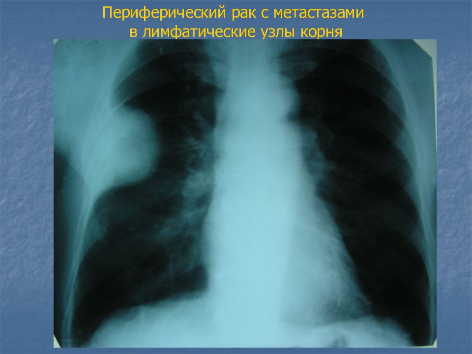 Рак с метастазами в лимфоузлы прогноз. Метастазы в легких рентген. Лимфоузлы метастазы в легких.