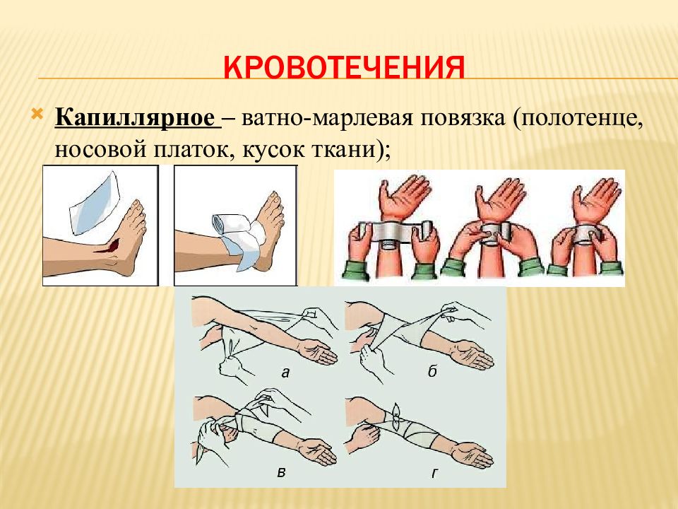 По рисунку определить вид кровотечения окажите помощь из имеющихся подручных средств