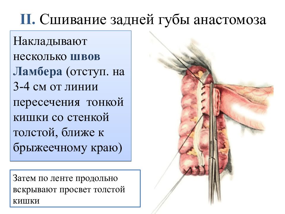 Кишечные анастомозы презентация