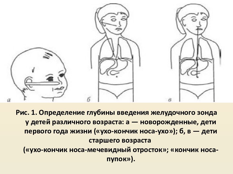 Введение желудочного зонда. Глубина введения желудочного зонда. Глубина введения зонда для промывания желудка. Введение зонда в желудок алгоритм.