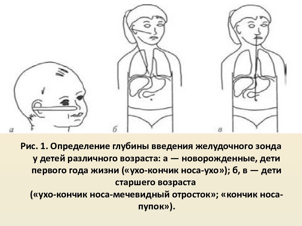 Измерение зонда. Введение желудочного зонда. Глубина введения желудочного зонда. Глубина введения зонда для промывания желудка. Введение зонда в желудок алгоритм.