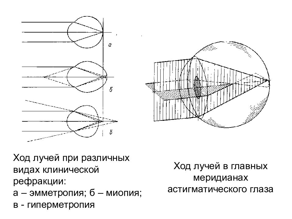 Нарисуйте схему преломления лучей при нарушениях и коррекции рефракции