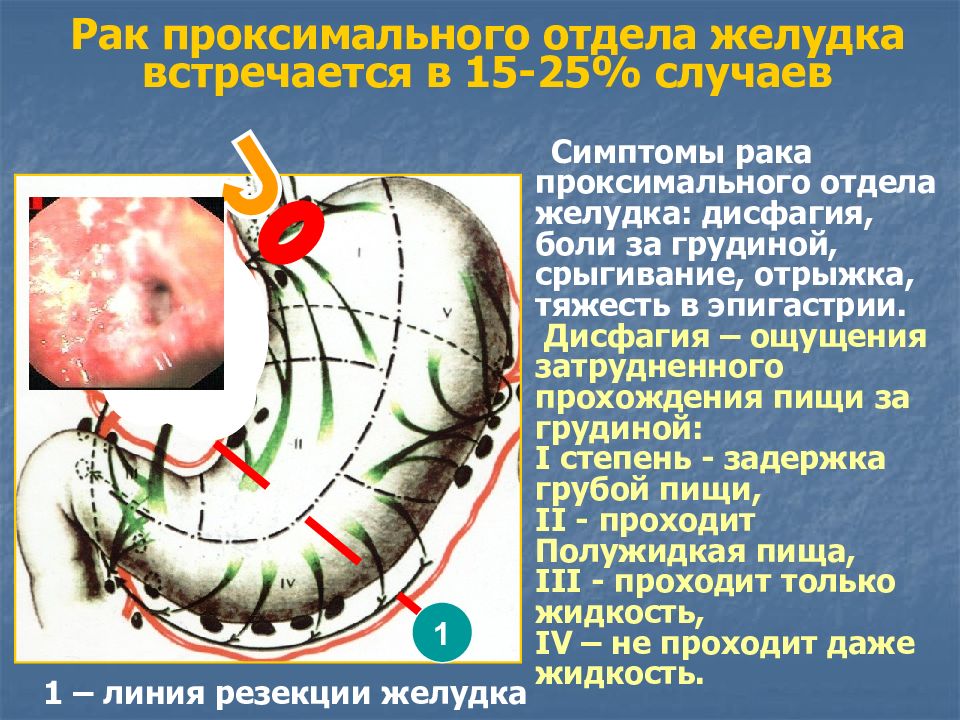 Лечение жел. Проксимальный отдел желудка. Кардиоэзофагеальный отдел желудка. Опухолевое поражение проксимальных отделов желудка. Опухоль проксимального отдела желудка.