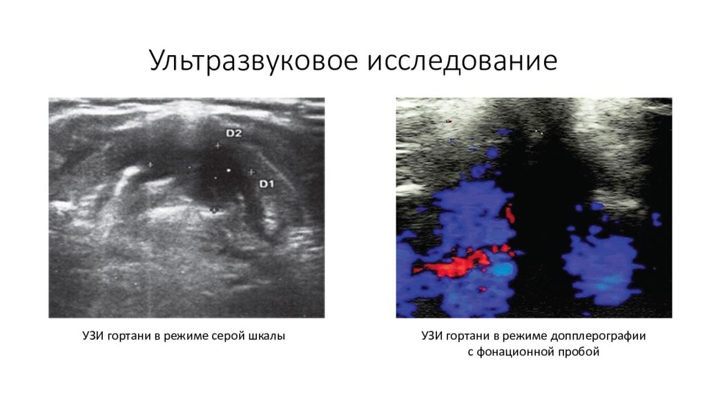 Узи гортани. Образование гортани на УЗИ. Ультразвуковая анатомия гортани.