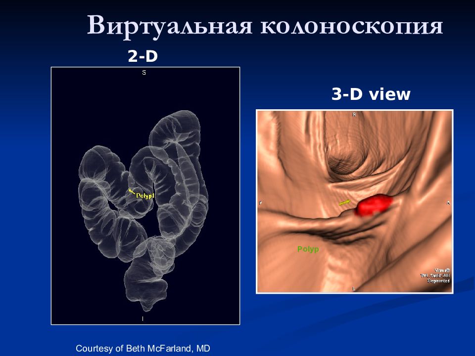 3 колоноскопия