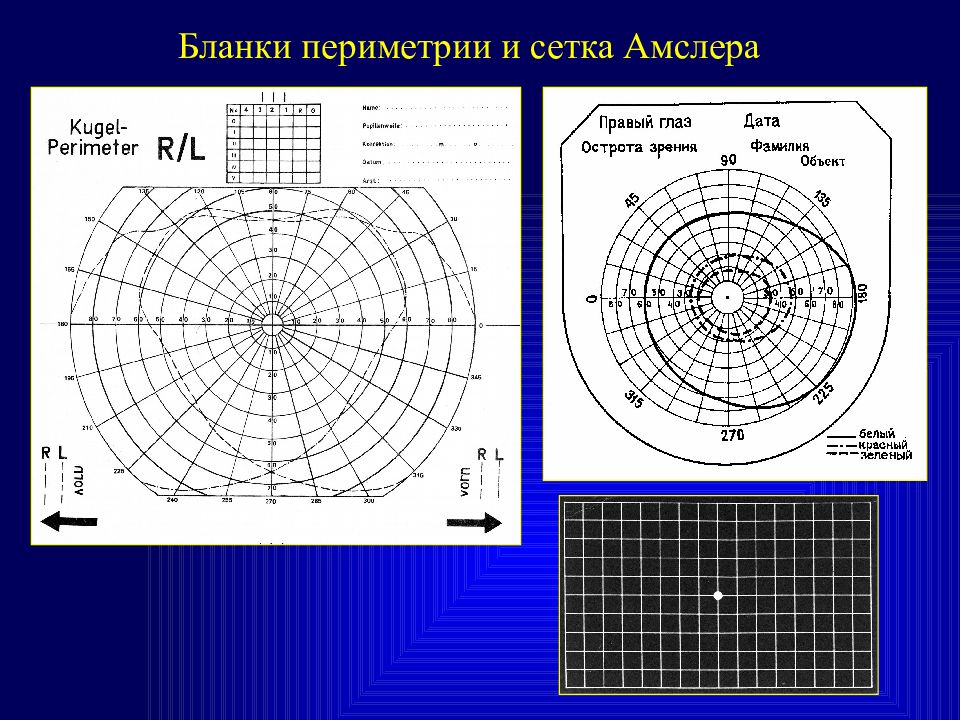 Периметрия в офтальмологии. Статическая периметрия норма. Исследование полей зрения периметрия норма. Статическая периметрия методика. Кинетическая периметрия норма.