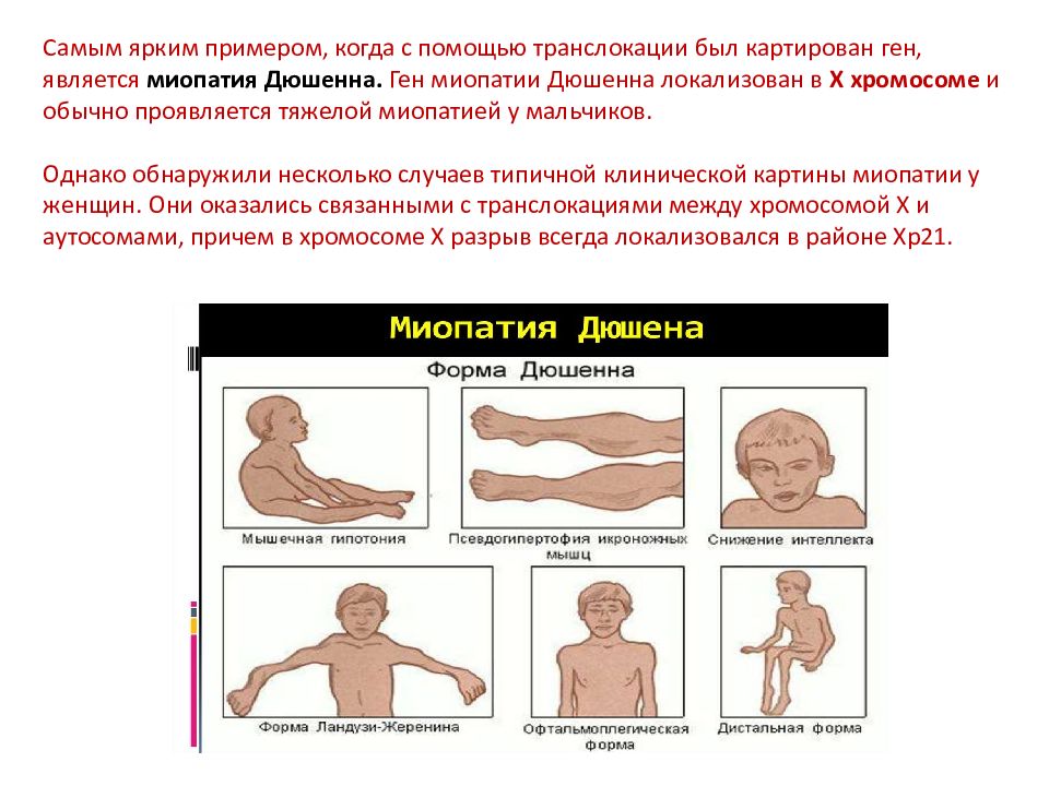 Генетическое картирование. Дистальная форма миопатии. Наиболее злокачественная форма миопатии. Миодистрофия Дюшенна лекции.