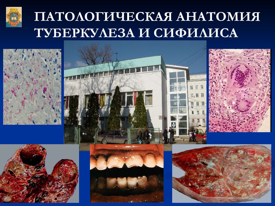 ПАТОЛОГИЧЕСКАЯ АНАТОМИЯ ТУБЕРКУЛЕЗА И СИФИЛИСА