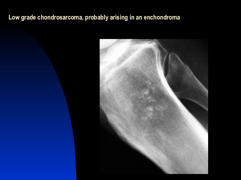 Хондросаркома. Хондросаркома рентгенодиагностика. Хондросаркома лопатки. Хондросаркома плечевой кости мрт.