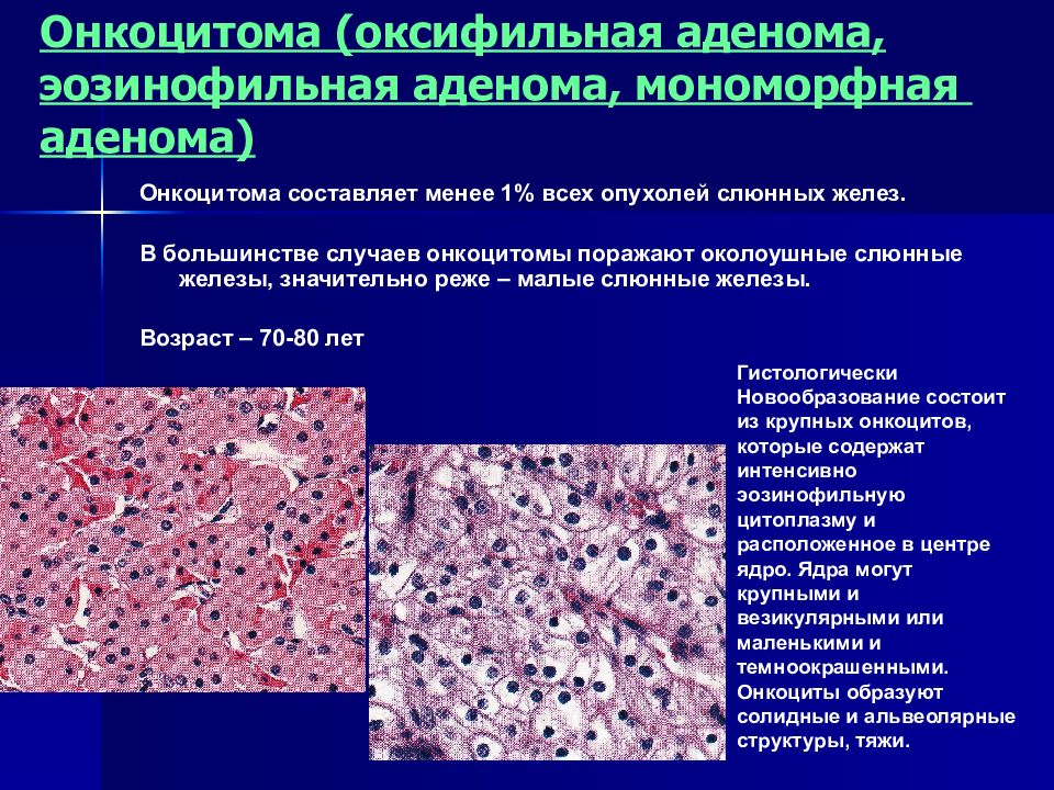 Атипия желез. Онкоцитарная аденома щитовидной железы гистология. Мономорфная аденома слюнной железы гистология. Плеоморфная аденома цитологическая картина. Аденома слюнной железы гистология.