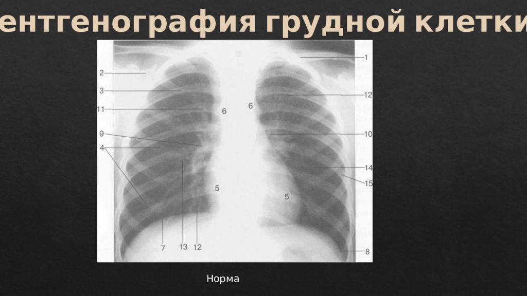 Рентген легких рисунок. Рентгенограмма органов грудной клетки норма. Рентгенография органов грудной клетки норма. Рентген органов грудной клетки норма. Рентгенография грудной клетки норма снимок.