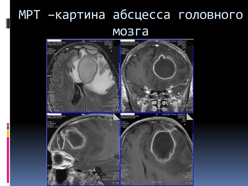 Презентация абсцесс головного мозга