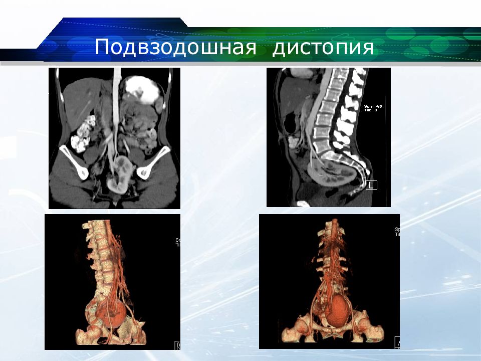 Перекрестная дистопия почки. Тазовая дистопия почки кт. Подвздошная дистопия почки.